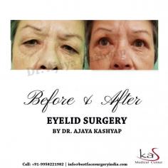 Eyelid Surgery, also known as Blepharoplasty, improves the appearance of the upper eyelids, lower eyelids, or both. It gives a rejuvenated appearance to the surrounding area of your eyes, making you look morerested and alert. Removes excess fat, muscle and skin from upper and lower eyelids giving them a more awake and youthful while improving the contour.
For any kind of enquire about, blepharoplasty procedure in Delhi, India please complete our contact form: https://www.bestfacesurgeryindia.com/book-an-appointment.php
Call us at our helpline numbers 91-9818369662, +91-9958221982.
YouTube: https://www.youtube.com/watch?v=jHItvdRVMxU&t=27s
Now New Address: Khasra no 541/542, MG Road, Aya Nagar, Metro Pillar 184, Near the Arjan Garh Metro Station, New Delhi 110047 (India)
#uppereyelid #lowereyelid #blepharoplasty #eyelidsurgery #beforeandafter #drkashyap #cosmeticsurgery #plasticsurgeon #Delhi #India
