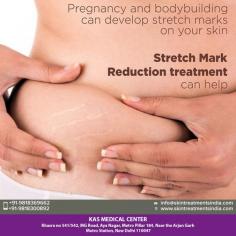 If you have been thinking about getting a best stretch marks treatment in Delhi, stretch marks treatment cost in India contact us for an appointment where we can discuss your requirements in more details. 

For more info visit www.skintreatmentsindia.com or call now on +91-9818300892 to book your consultation.

#StretchMarks #Carboxytherapy #ChemicalPeels #SmoothbeamLaser #SurgicalDermabrasion #NonSurgical #StretchMarksTreatmentinDelhi
