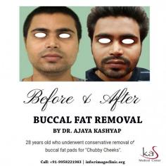 Buccal fat removal is a surgery that reduces the size of your cheeks. A surgeon removes the buccal fat pads, creating a slimmer face.

For more information buccal fat removal surgery, or to schedule a consultation, please call Dr. Ajaya Kashyap Clinic (KAS Medical Center) today at +91-9818369662, 9958221983 or use our online appointment request form.

Visit: www.imageclinic.org
#buccalfatreduction #buccalfatremoval #buccalfatpadremoval #cosmeticsurgery #plasticsurgeon #drkashyap #delhi #india
