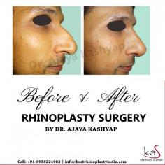 Unhappy with the shape or size of your Nose? Rhinoplasty can correct any flaw & reconstruct the nose to address any deformity or breathing issue.
Contact us anytime with any questions you may have, or to schedule your consultation for rhinoplasty surgery in Delhi, India.
CONTACT US:-
Dr. Ajaya Kashyap
WhatsApp:
https://api.whatsapp.com/send?phone=919958221982
Mobile: +91-9818369662, 9958221982
Web: www.bestrhinoplastyindia.com

#rhinoplasty #nosesurgery #nosereshaping #smallnose #widenose #broadnose #nosejob #plasticsurgery #plasticsurgeon #cosmeticsurgery #cosmeticsurgeon #bestplasticsurgeon #topplasticsurgeon #KasMedicalCenter #Delhi #India
