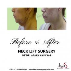 If you are get rid and want a solution for sagging neck and loose skin. We have neck lift surgery for those patients who have loose elastic skin and suffer from saggy neck.
For more information about neck lift surgery, or to schedule a consultation, please call Dr. Ajaya Kashyap Clinic (KAS Medical Center) today at +91-9818369662, 9958221982 or use our online appointment request form.

Consult your plan for neck lift surgery with our US Board Certified Plastic Surgeon via appointment at:

WhatsApp Direct Link: https://api.whatsapp.com/send?phone=919818369662
Get more information at: www.bestfacesurgeryindia.com
Now New Address: Khasra no 541/542, MG Road, Aya Nagar, Metro Pillar 184, Near the Arjan Garh Metro Station, New Delhi 