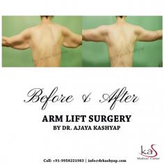 Arm Lift Surgery Delhi is the procedure to reduce extra fat from your body. Some people have the problem of saggy arms and wants to tighten their skin this the only best option to tighten the skin through arm lift surgery.
For more details and see before & after our national & international patients. 
Contact us anytime with any questions you may have, or to schedule your consultation for arm lift cosmetic surgery in Delhi, India. 
For any kind of enquire about, arm lift procedure please complete our contact form https://www.bestbodyliftsurgery.com/make-an-enquiry.html
Send Your Query: info@bestbodyliftsurgery.com
#medspaclinic #southwestdelhi #cosmeticsurgery #estheticsurgery #armlift #arm #armlifting #armreduction #brachioplasty #breastaugmentation #breastlift #breastlifaugmentation #bodylift #abdominoplasty #plasticsurgery #bbl #mommymakeover
