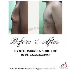 The gynecomastia procedure, when done well, will remove the gland and sculpt the fat to give the chest a more aesthetic and sculpted appearance. Sometimes a lift and liposuction under the arms gives a more sculpted look.
Contact Dr. Kashyap Clinic (KAS Medical Center) at +91-9958221983, 9958221982 to book a consultation or ask us a question.
Check out more details: www.bestgynecomastiaindia.com
#Gynecomastia #MaleBreastReduction #CosmeticSurgery #PlasticSurgeon #Drkashyap #Delhi #India #medicaltourism
