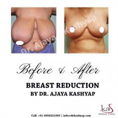 KAS medical Center has experienced surgeon and also have many years of experience in this field. If you are looking for the Breast Reduction Surgery in Delhi then you can undoubtedly go with KAS medical Center.

Contact us anytime with any questions you may have, or to schedule your consultation for wise pattern breast reduction in Delhi, India. 

CONTACT US:-

WhatsApp Direct Link:
https://api.whatsapp.com/send?phone=919958221983
Mobile: +91-9818369662, 9958221983
Email: info@drkashyap.com
Web: www.drkashyap.com
YouTube Video:https://www.youtube.com/watch?v=o_gLAioi1Oo&t=23s

#BreastReduction #WisePatternBreastReduction #CosmeticSurgery #DrKashyap
