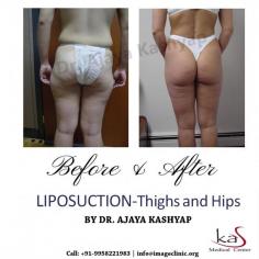 Liposuction is cosmetic surgery in which deposits of fat are removed to reshape or reduce one or more areas of the body. Common areas targeted include thighs, buttocks, abdomen, arms, neck and under the chin.
Contact us anytime with any questions you may have, or to schedule your consultation for liposuction surgery in Delhi, India. Please call Dr. Ajaya Kashyap Clinic (KAS Medical Center) today at +91-9818369662, 9958221983 or use our online appointment request form.

WhatsApp Direct Link: https://api.whatsapp.com/send?phone=919818369662
Book Your Consultation: https://www.imageclinic.org/request-callback.html
Email: info@imageclinic.org

#liposuction #thigh #hips #vaserliposuction #tummyfatremoval #abdominal #cosmeticsurgeryindia #plasticsurgeondelhi #drkashyap
