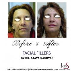 Dermal fillers are gel-like substances that are injected beneath the skin to restore lost volume, smooth lines and soften creases, or enhance facial contours.
Book your appointment now.!!!!!!
Also, join us on our Instagram page or our website or You can ask for your appointment from our online booking portal as well as by calling us at +91-9818963662, +91-9818300892
Visit Website: https://www.skintreatmentsindia.com/fillers.html
#facialfiller #dermalfiller #filller #skintreatment #skintratmentclinic #nonsurgical #undereyedarkcircle #lipaugmentation #chinaugmentation #nosefiller #acnescar
