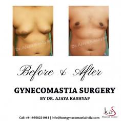 One of the most effective treatments for this condition is to go for a surgery. And it is a common approach because it is only one of the only guaranteed ways to resolve gynecomastia.

Get the best Cosmetic and Plastic surgery in India at KAS Medical Center. For any kind of enquire about, enlarge male breast reduction procedure please complete our contact form or call +91-9818963662 or +91-9958221983.
Email: info@bestgynecomastiaindia.com
Web: www.bestgynecomastiaindia.com

#malebreastreduction #gynecomasiasurgeon #cosmeticsurgeryclinic #plasticsurgeonindia #bestgynecomastiaindia
