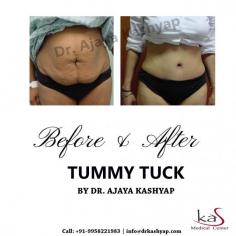 Tummy Tuck Surgery can resolve contours of the abdomen by removal of excess skin and underlying fat. Get flatter, firmer belly at KAS Medical Center, Delhi, India.
Share your whatsapp number, contact number or email id to get immediate help. You can also visit www.drkashyap.com to know details.
For any kind of enquire about, Tummy Tuck or Abdominoplasty surgery please complete our contact form or call +91-9818963662 or +91-9958221983.

#tummytuck #tummytuckSurgeon #abdominoplasty #cosmeticsurgeryindia #plasticsurgeondelhi #kasmedicalcenter #DrAjayaKashyap

