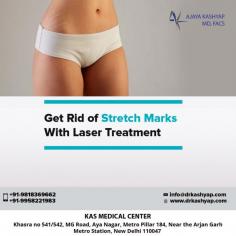 Stretch marks are caused by a rapid expansion of skin due to pregnancy or weight gain. When skin is stretched excessively it causes tiny tears in the second layer of skin, and in many cases the top layer of skin, leaving stretch marks

For more information about Stretch marks treatment, or to schedule a consultation, please call Dr. Ajaya Kashyap Clinic (KAS Medical Center) today at +91-9818369662, 9958221983 or use our online appointment request form.

Visit: https://www.drkashyap.com/cosmetic-plastic-surgery/stretch-marks.html

#stretchmarks #nonsurgical #lasertreatment #skintreatment #cosmeticsurgery #plasticsurgeon #Delhi 
