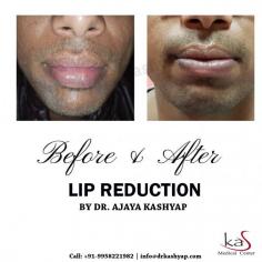 Some people find the size of their lips maybe to large for their face. Lip Reduction reduces the size of abnormally thick lips.
If you have been thinking about getting a lip reduction surgery in Delhi, lip reshaping procedure cost in India contact us for an appointment where we can discuss your requirements in more details. You can call us at +91-9958221983 or email us at info@drkashyap.com.

#lipreduction #lipreductionsurgeon #cosmeticsurgeryinindia #cosmeticsurgeonindelhi #plasticsurgeryinindia #plasticsurgeonindelhi #DrAjayaKashyap #drkashyap
