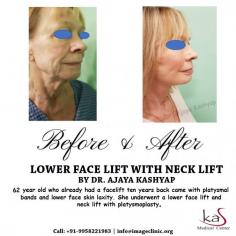 KAS medical Center has experienced surgeon and also have many years of experience in this field. If you are looking for the Lower Face Lift with Neck Lift Surgery in Delhi then you can undoubtedly go with KAS medical Center.

For more information about lower face lift and neck lift surgery, or to schedule a consultation, please call Dr. Ajaya Kashyap Clinic (KAS Medical Center) today at +91-9818369662, 9958221983 or use our online appointment request form.

Consult your plan for lower face lift with neck lift surgery with our US Board Certified Plastic Surgeon via appointment at:

WhatsApp Direct Link: https://api.whatsapp.com/send?phone=919818369662
Get more information at: www.imageclinic.org
#lowerfacelift #necklift #cosmeticsurgery #drkashyap