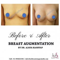 Looking to improve the shape and size of your breasts?
Don’t worry. You are at the right place. BREAST AUGMENTATION can help you get add fullness to the breasts so that you don’t feel embarrassed about yourself. Lest assured, it’s completely safe.
His 27 years of experience and qualifications being a Triple American Board certified plastic surgeon allows him to deliver the best cosmetic surgery at affordable cost in Delhi.
Book your appointment now.!!!!!!
Also, join us on our Instagram page or our website or You can ask for your appointment from our online booking portal as well as by calling us at +91-9818963662, +91-9958221982
Visit Website: www.bestbreastsurgeryindia.com


#breastaugmentation #autologousfattransfer #breastimplant #breastenlargement #breastsurgeon #plasticsurgeonindia #breast #breastsurgery #beauty #clinic

