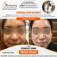 HYDRATION & GLOW TREATMENT IN DELHI- BEST DERMATOLOGIST IN DELHI- DR. SURUCHI PURI
✔️Concern - Uneven Skin Tone & Dull Skin
✔️Treatment - Hydration & Glow treatment 
Below are the images of our patient. She had issues of uneven skin tone & Dull skin. 
So we gave her a couple of hydration & Glow treatments and the results you can see below !
For More information:
