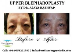 If you have been thinking about getting a upper eyelid surgery in Delhi contact us for an appointment where we can discuss your requirements in more details. You can call or whatsapp +91-9958221982
Check out more details: www.bestfacesurgeryindia.com

#eyelidsurgery #uppereyelid #lowereyelid #blepharoplasty #eyebags #beforeandafter #DrKashyap #cosmeticsurgery #plasticsurgeon #Delhi #India
