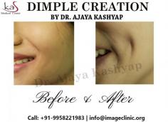KAS medical Center has experienced surgeon and also have many years of experience in this field. If you are looking for the dimple creation surgery in Delhi then you can undoubtedly go with KAS medical Center.
For more information about dimpleplasty surgery, or to schedule a consultation, please call Dr. Ajaya Kashyap Clinic (KAS Medical Center) today at +91-9818369662, 9958221982 or use our online appointment request form.

Web: https://www.imageclinic.org

#dimple #dimpleplasty #creation #cosmeticsurgery #plasticsurgeon #Delhi #India 
