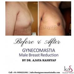 Hate wearing tight T-shirts or taking your shirt off at the beach? 1 out of every 5 men suffer from Gynecomastia. If you are one of them, do not panic. Gynecomastia is a fully treatable condition.

CONTACT US:-

WhatsApp Direct Link:
https://api.whatsapp.com/send?phone=919818369662
Mobile: +91-9818369662, 9958221983
Email: info@bestgynecomastiaindia.com
Web: www.bestgynecomastiaindia.com

#gynecomastia #plasticsurgery #malebreastreduction #breastreduction #gyneco #men #cosmeticsurgery #beauty #plasticsurgeon #surgery #happypatient #realpatient #review #realself #lifestyle #traveling #travel #instagram
