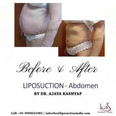 If you have been thinking about getting a liposuction surgery in Delhi contact us for an appointment where we can discuss your requirements in more details. 
Share your whatsapp number, contact number or email id to get immediate help. You can also visit www.bestliposuctionindia.com to know details.
For any kind of enquire about, liposuction abdomen surgery please complete our contact form or call +91-9818963662 or +91-9958221983.

#liposuction #abdomen #plasticsurgery #surgery #transformation #mommy #bodyjet #vaserliposuction #cosmeticsurgeryindia #whatsapp
