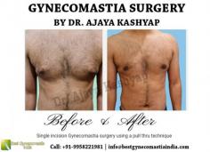 If you are looking for a best gynecomastia surgeon in Delhi to get a male breast Reduction surgery in Delhi, India at affordable cost/price. You may visit us for a confidential consultation on procedures by our expert plastic cosmetic surgeon Dr. Ajaya Kashyap. 

Call: +91-9958221981
Email: info@bestgynecomastiaindia.com
Web:  www.bestgynecomastiaindia.com

Tag: #gynecomastia #malebreastreduction #gynecomasiasurgeon #cosmeticsurgeryclinic #plasticsurgeonindia #bestgynecomastiaindia
