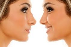 The best candidates for Rhinoplasty are people who are looking for improvement, not perfection, in the way they look. If you're physically healthy, psychologically stable, and realistic in your expectations, you may be a good candidate.

Rhinoplasty can be performed to meet aesthetic goals or for reconstructive purposes-to correct birth defects or breathing problems.

Age may also be a consideration. Many surgeons prefer not to operate on teenagers until after they've completed their growth spurt-around 14 or 15 for girls, a bit later for boys.

Book an Appointment: www.bestrhinoplastyindia.com

Whatsapp: https://api.whatsapp.com/send?phone=919289988888

Check Out Full Video: https://www.youtube.com/watch?v=0hMYsVBCSWs

#SeptoRhinoplasty #Rhinoplasty #NoseSurgery #CosmeticProcedure #NonSurgical #Delhi #Intenational #Packages #MedicalTourism #quickrecovery #BoardCertifiedPlasticSurgeon #Beauty #cosmeticsurgeon 
