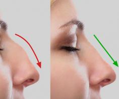 Are you worried about the shape of your nose and if you are thinking about rhinoplasty surgery, then you can consult Dr. Ajaya Kashyap who is a US board certified surgeon.
Contact us anytime with any questions you may have, or to schedule your consultation for nose surgery clinic in Delhi, India.

Dr. Ajaya Kashyap
Call: +91-9958221983
Email: info@bestrhinoplastyindia.com
Web: www.bestrhinoplastyindia.com

#rhinoplasty #nosesurgery #nosejob #nosereshaping #clinic #delhi #india #cosmeticsurgery #plasticsurgeon
