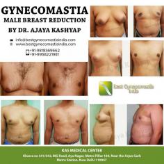 If you have been thinking about getting a Gynecomastia Surgery in India contact us for an appointment where we can discuss your requirements in more details. You can call us at +91-9958221981 or email us at info@bestgynecomastiaindia.com. 
For more info visit: www.bestgynecomastiaindia.com
#gynecomastia #malebreastreductionindelhi #cosmeticsurgery #plasticsurgeonindia #gynecomastiaclinicdelhi #Drkashyap
