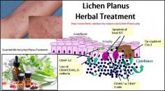 Lichen Planus Causes, Symptoms, Diagnosis and Herbal Treatment