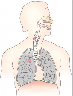 Home Remedies for Achalasia and Achalasia Natural Treatment like homeopathy and the use of essential oils etc mainly focus on providing symptomatic relief to patients. Before we study ways to manage achalasia at home, let us take a look at its causes and symptoms. Coconut Oil Buy Herbal Product for Achalasia Numerous patients have helped using coconut oil for achalasia. Start with one tablespoon of virgin coconut oil every day.
