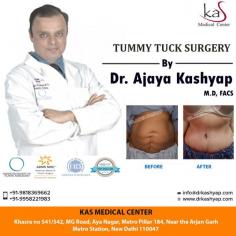 Tummy tuck surgery is good option for those women who have just finished having children often want to regain their pre-pregnancy figures. Contact us today inquire about abdominoplasty surgery cost in Delhi.

Schedule a consultation by:

Dr. Ajaya Kashyap
Email: info@drkashyap.com
Web: www.drkashyap.com
Call: +91-9958221983
For Pricing: Text +91-9958221983
Location: Khasra no 541/542, MG Road, Aya Nagar, Metro Pillar 184, Near the Arjan Garh Metro Station, New Delhi, India

#tummytuck #tummytucksurgery #abdominoplasty #abdominoplastycost #abdominoplastysurgeon #cosmeticsurgery #plasticsurgery #DrAjayaKashyap


