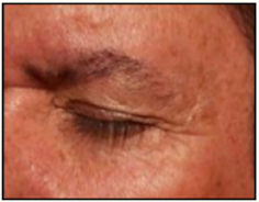 We have developed an effective blemish removal product Free Of Blemishes that has become the premier dark blemishes on face, freckles, moles, age spots, skin tags, DSAP removal product. Your blemishes will never return. We offer money back guarantee. If you are thinking of spending $100 to $300 for various low cost home treatment, or planning to visit dermatologists that charge $500, then try our product at least once, and see the difference. You get at a price of $100 that you can’t find elsewhere. Get in touch with us now, visit free-of-blemishes.com!