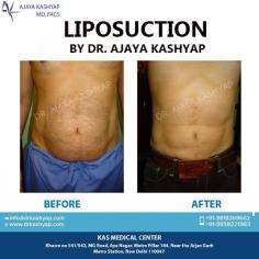 Liposuction is cosmetic surgery in which deposits of fat are removed to reshape or reduce one or more areas of the body. Common areas targeted include thighs, buttocks, abdomen, arms, neck and under the chin
Contact us anytime with any questions you may have, or to schedule your consultation for cosmetic and plastic surgery clinic in Delhi, India.
Dr. Ajaya Kashyap
Call: +91-9958221983
Email: info@bestliposuctionindia.com
Web: www.bestliposuctionindia.com

#plasticsurgery #surgery #transformation #vaserlipo #bodyjetlipo #liposuction #tummytuck #breastsurgery

