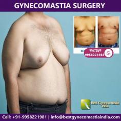 Gynecomastia surgery is performed by our expert plastic surgeon, Dr. Ajaya Kashyap. He is regarded as the gynecomastia surgeon in India due to his 30 years of surgical experience and being a Triple American Board certified Plastic Surgeon. The search to get the  gynecomastia surgery leads you to have your male breast reduction Delhi. Dr. Ajaya Kashyap, your specialist gynecomastia surgeon in Delhi, may perform the procedure with liposuction and gland excision, or just liposuction alone.


Men who have excessive male breasts know the embarrassment and emotional stress the condition brings along. However, you have do not have to live with female-like breasts. Male breast reduction surgery helps you discover an all new you. Medically known as Gynecomastia, the surgery has proved to be a blessing for many men across the globe. Do not let your self-confidence and self-esteem get dampened because of excessive breasts. Get ready to be swimsuit ready with the gynecomastia surgery and experience change in your life. If you are looking for male breast reduction surgery cost in Delhi or gynecomastia surgery cost in India contact us anytime.


Get more information: https://www.bestgynecomastiainida.com​

Book an Appointment Call: +91-9958221981

Our email: info@bestgynecomastiaindia.com

Gynecomastia Surgery Video: https://www.youtube.com/watch?v=-JbK5qAD-X4

#gynecomastia #malebreastreductionindelhi #cosmeticsurgery #plasticsurgeonindia #liposuction #gynecomastiaclinicdelhi #Drkashyap
