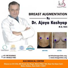 Breast augmentation has a long and successful track record in satisfying women who wish to enhance, regain or restore balance to their figures. Consult your plan for Breast Implant surgery with our US Board Certified Surgeon via appointment.
	
Schedule a virtual consultation by:
Phone: 995-822-1981
For Pricing: Text 995-822-1981
Website: www.imageclinic.org
Location: Khasra no 541/542, MG Road, Aya Nagar, Metro Pillar 184, Near the Arjan Garh Metro Station, New Delhi, India
Note: Individual results may vary.⁣

OUR PATIENT FROM:-
#USA, #UK, #Canada, #Australia, #NewZealand, #Nigeria, #Kenya, #Ethiopia, #Uganda, #Tanzania, #Zambia, #Congo, #SriLanka, #Bangladesh, #Afghanistan, #Nepal, #Uzbekistan

#breastaugmentation #autologousfattransfer #breastimplant #breastenlargement #breastsurgeon #plasticsurgeonindia
