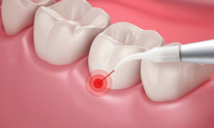 Gum Disease Laser Therapy in the Virgin Islands

Dr. Jones, Dr. Jones, Dr. Cabbell, Dr. Tingling, Dr. Wensing or Dr. Wall is proud to offer the latest technology available for periodontal therapy: laser treatment.