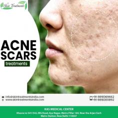 Do you want to get rid of the stubborn acne scars of your skin, and give your skin a natural glowing look? Then,visit KAS Medical Center today and get the Acne Scar Treatment done. Contact us today inquire about acne scar treatment cost in Delhi.

Take Video Consultation with our doctor from the comfort of your home.To book an appointment for Video Consultation Call or Whatsapp: +91-9818300892

Schedule a consultation by:
Dr. Ajaya Kashyap
Email: info@skintreatmentsindia.com
Web: www.skintreatmentsindia.com
Location: Khasra no 541/542, MG Road, Aya Nagar, Metro Pillar 184, Near the Arjan Garh Metro Station, New Delhi, India

#Acne #Scars #AcneScarTreatment #SkinCare #NonSurgical #LoveforSkin #Delhi
