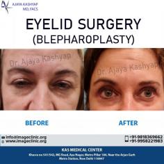 Blepharoplasty is the medical term for cosmetic eyelid surgery. It’s a popular procedure that continues to gain in stature because it helps rejuvenate a tired and aging appearance caused by droopy eyelids. Contact us anytime with any questions you may have, or to schedule your consultation for Eyelid cosmetic surgery in Delhi, India. 

Schedule a consultation by:
Dr. Ajaya Kashyap
Email: info@imageclinic.org
Web: www.imageclinic.org
Location: Khasra no 541/542, MG Road, Aya Nagar, Metro Pillar 184, Near the Arjan Garh Metro Station, New Delhi, India

#blepharoplasty #eyelidsurgery #lowereyelid #uppereyelid #cosmeticsurgery #plasticsurgeon  #realpatient #beauty #realself
