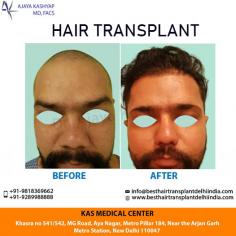 Looking for a hair transplant program with no stitches, incisions or pain? Dr. Ajaya Kashyap's cutting-edge, minimally invasive technique is the ultimate choice for natural-looking and permanent results. Contact us today inquire about hair transplant procedure cost in Delhi.

Schedule a consultation by:

Dr. Ajaya Kashyap
Phone: +91-9289988888
For Pricing: Text +91-9289988888
Email: info@besthairtransplantdelhiindia.com
Website: www.besthairtransplantdelhiindia.com
Location: Khasra no 541/542, MG Road, Aya Nagar, Metro Pillar 184, Near the Arjan Garh Metro Station, New Delhi, India

#HairTransplant #FUE #FUT #HairLoss #PRP #Beard #Moustaches #Eyelash #Eyebrows #PlasticSurgery #realpatient #realself #lifestyle #traveling #Hair #Travel #MedicalTourism #Men #Women #EMI
