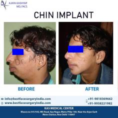 Chin augmentation using surgical implants can alter the underlying structure of the face, providing better balance to the facial features. Need Chin Implant procedure in Delhi, India. Meet Triple American Board Certified surgeon Dr. Ajaya Kashyap.

Schedule a consultation by:

Dr. Ajaya Kashyap
Email: info@bestfacesurgeryindia.com
Web: www.bestfacesurgeryindia.com
Call: +91-9958221982
For Pricing: Text +91-9958221982
Location: Khasra no 541/542, MG Road, Aya Nagar, Metro Pillar 184, Near the Arjan Garh Metro Station, New Delhi, India

#chinaugmentation #chinimplant #plasticsurgeon #facesurgeon #realpatient #beauty #realself #cosmeticsurgery #drkashyap #delhi #india
