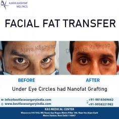 Fat grafting is a procedure that restores volume in the face to reduce creases or pitted scars and improve the facial contours. The procedure, also known as fat transfer, takes fat from one part of the body and injects it into the face.

Schedule a consultation by:

Dr. Ajaya Kashyap
Email: info@bestfacesurgeryindia.com
Web: www.bestfacesurgeryindia.com
Call: +91-9958221982
For Pricing: Text +91-9958221982
Location: Khasra no 541/542, MG Road, Aya Nagar, Metro Pillar 184, Near the Arjan Garh Metro Station, New Delhi, India

#fatgrafting #facialfattransfer #nanofatgrafting #undereyecircles #fattransfer #facialrejuvenation #cosmeticsurgerydelhi #plasticsurgeonindia
