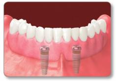 Virgin Island Dental Center | Implant Retained Dentures

Usually, when you lose a tooth, it is best for your oral health to have it replaced. Missing teeth can affect your “bite” as well as your ability to speak and chew.