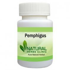 Pemphigus symptoms include painful blisters in the mouth or skin. Pemphigus Natural Herbal Treatment can help keep the symptoms under control and reduce the causes.