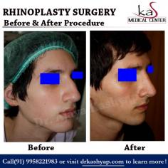 Need Best Nose Reshaping Surgery in Delhi, India. Meet Triple American Board Certified surgeon Dr. Ajaya Kashyap. Take Video Consultation with our doctor from the comfort of your home. To book an appointment for Video Consultation Call or Whatsapp: +91-9958221982

Schedule a consultation by:
Dr. Ajaya Kashyap
Call or Whatsapp: +91-9958221982
Email: info@bestrhinoplastyindia.com
Web: www.bestrhinoplastyindia.com
Location: Aya Nagar, New Delhi, India

#Rhinoplasty #NoseSurgery #NoseJob #NoseReshaping #CosmeticSurgeon #KASMedicalCenter #DrAjayaKashyap #Medspa #Delhi #India #BoardCertifiedPlasticSurgeon 