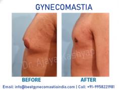 Looking for Best Gynecomastia Surgery in Delhi, India? We at cosmetic plastic surgery clinic, provide Male Breast Reduction Surgery at affordable cost/ price in Delhi, india by US board certified surgeon - Dr. Ajaya Kashyap at KAS Medical Center.
Take Video Consultation with our doctor from the comfort of your home. To book an appointment for Video Consultation Call or Whatsapp: +91-9958221981

CONTACT US:-
Dr. Ajaya Kashyap (MD, FACS)
Mobile: +91-9818369662, 9958221981
Email: info@bestgynecomastiaindia.com
Web: www.bestgynecomastiaindia.com
Location: Khasra no 541/542, MG Road, Aya Nagar, Metro Pillar 184, Near the Arjan Garh Metro Station, New Delhi, India

#gynecomastiasurgery #gynecomastia `#bestgynecomastiaindia #malebreastreduction #vaserliposuction #drkashyap
