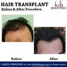Let your search for the best hair transplant procedure in Delhi come to an end with best hair transplant surgeon in Delhi, Dr. Ajaya Kashyap. With an experience spanning over 30 years in the field of cosmetic and plastic surgery, he has emerged as the leading hair transplant surgeon in India.
Please call us (+91-9289988888) and inquire (info@besthairtransplantdelhiindia.com) about the Hair Treatment Cost in Delhi, with Dr. Ajaya Kashyap - your Hair Transplant Surgeon in New Delhi, female hair fall treatment clinic in delhi.
