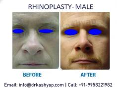 Looking for Best Rhinoplasty Surgery in Delhi, India? We at cosmetic plastic surgery clinic, provide Nose Reshaping at affordable cost/ price in Delhi, india by US board certified surgeon - Dr. Ajaya Kashyap at KAS Medical Center.
Take Video Consultation with our doctor from the comfort of your home. To book an appointment for Video Consultation Call or Whatsapp: +91-9958221982

CONTACT US:-
Dr. Ajaya Kashyap (MD, FACS)
Mobile: +91-9818369662, 9958221982
Email: info@drkashyap.com
Web: www.drkashyap.com
Location: Khasra no 541/542, MG Road, Aya Nagar, Metro Pillar 184, Near the Arjan Garh Metro Station, New Delhi, India

#rhinoplasty #nosesurgery #nosejob #nosereshaping #clinic #delhi #india #cosmeticsurgery #plasticsurgeon