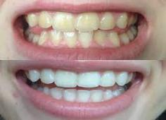 How to Cure Swollen Lower Gums Las Vegas
https://urgentdentalusa.com/services/swollen-face/
