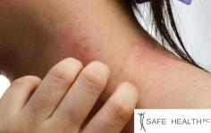 At Safe Health & Med Spa is a dermatologist and medical aesthetic specialist who compassionately treats patients of all ages to relieve eczema symptoms long term. While there’s no cure for eczema, Dr. Saif Fatteh can help you control flare-ups with a holistic approach to treatment. Call to schedule an exam today, or click the button to request an appointment. https://www.safehealthcenter.com/skincare-services/eczema-treatment/