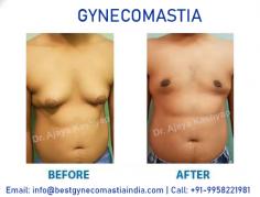 Gynecomastia surgery is performed by our expert plastic surgeon, Dr. Ajaya Kashyap. He is regarded as the best gynecomastia surgeon India due to his 30 years of surgical experience and being a Triple American Board certified Plastic Surgeon. The search to get the best gynecomastia surgery leads you to have your male breast reduction Delhi. Dr. Ajaya Kashyap, your specialist gynecomastia surgeon in Delhi, may perform the procedure with liposuction and gland excision, or just liposuction alone.

Take Video Consultation with our doctor from the comfort of your home. To book an appointment for Video Consultation Call or Whatsapp: +91-9958221981

Schedule a consultation by:
Dr. Ajaya Kashyap
Call or Whatsapp: +91-9958221981
Email: info@bestgynecomastiaindia.com
Visit: https://www.bestgynecomastiaindia.com
Location: Aya Nagar, New Delhi, India

#gynecomastiasurgery #gynecomastia #bestgynecomastiaindia #bestoffer #glandexcision #malebreastreduction #vaserliposuction #drkashyap

