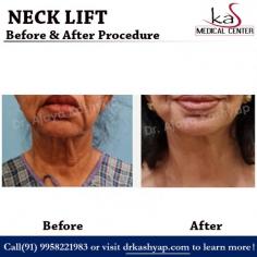 Men and women, usually over 40, with wrinkled or sagging neck skin. Sometimes called a cervicoplasty, the neck lift procedure tightens loose neck skin for a younger and fresher appearance. If you have been thinking about getting a Neck lift surgery in India contact us for an appointment where we can discuss your requirements in more details. You can call us at +91-9818369662, +91-9958221983 or email us at info@drkashyap.com.

WhatsApp: https://api.whatsapp.com/send?phone=919958221983
Visit us: www.drkashyap.com

#necklift #cosmeticsurgery #plasticsurgeon #realpatient #drkashyap #delhi #india 