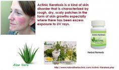 What Can Do For Actinic Keratosis
Actinic Keratosis Natural treatment and Actinic Keratosis Herbal Treatment is utilizing herbal medication. It is prescribed to take these pills every day. At first the spots will turn red however with time, they will begin to disappear. You can utilize it couple of months it a couple week after this, in order to keep your skin healthy. 
https://www.naturalherbsclinic.com/blog/what-can-do-for-actinic-keratosis/
