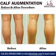 Calf augmentation with implants is a cosmetic surgical procedure that helps enhance, reshape and better define the contours of the lower leg.

If you are thinking about getting a Calf Augmentation with Silicone Gel Implant procedure in Delhi, India, set up an appointment with Dr. Ajaya Kashyap and discuss it. Dr. Ajaya Kashyap Triple American Board certified Plastic Surgeon with over 30 years of experience in which 16 years in the U.S.A. & from the past 14 years he is in Delhi. You can learn more about on his website - www.drkashyap.com

We are offering VIRTUAL CONSULTATIONS so that we can all stay connected during this time! 

Call Us today & Book a Consultation: +91-9958221983, +91-9958221982

#CalfEnlargement​ #CalfAugmentation​ #CalfEnhancement #SiliconeGelImplant #CosmeticSurgery #PlasticSurgeon​ #Delhi​ #India

